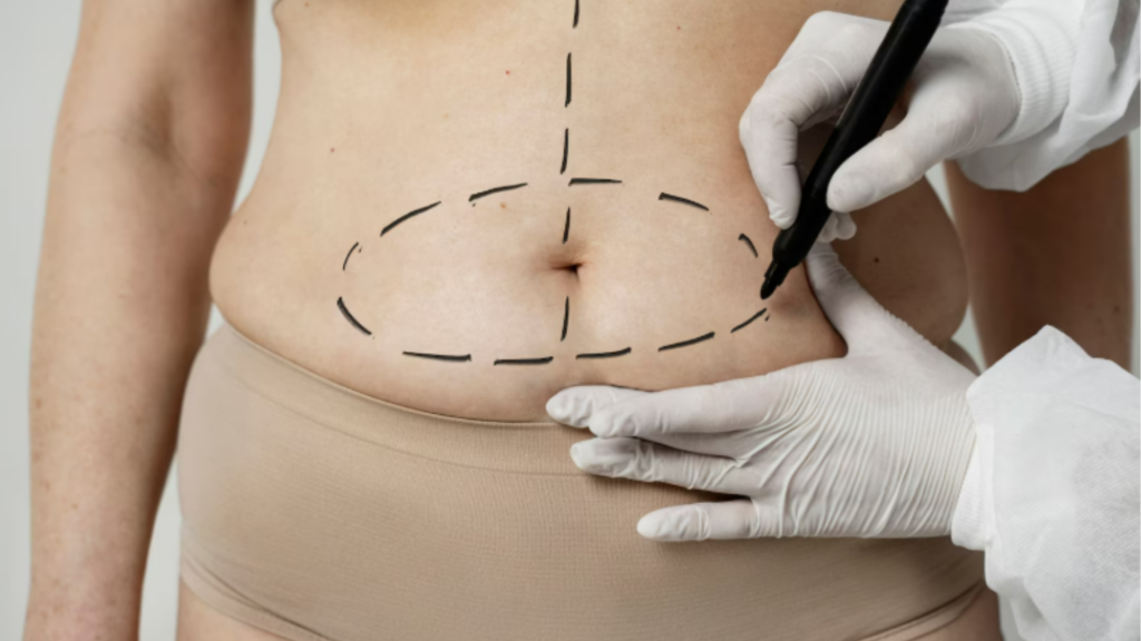 Lipoaspiração | Dr. Gilberto Teles