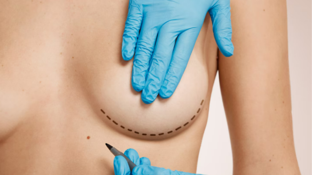 Mamoplastia de Aumento | Dr. Gilberto Teles